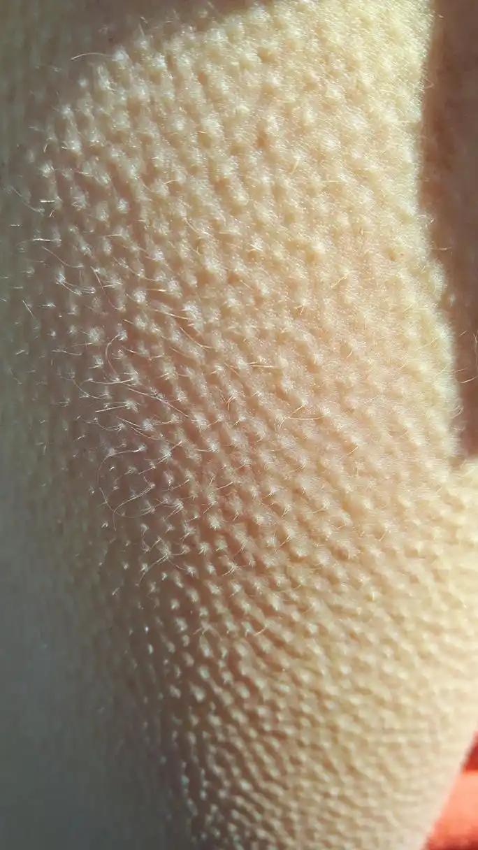 鸡皮肤,也称为角质过度增生,是指皮肤表面出现粗糙,颗粒状的小突起