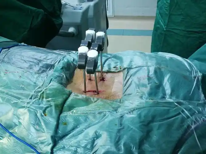 脊柱微创骨科苏安平团队完成经皮可扩张通道下mis_tlif手术