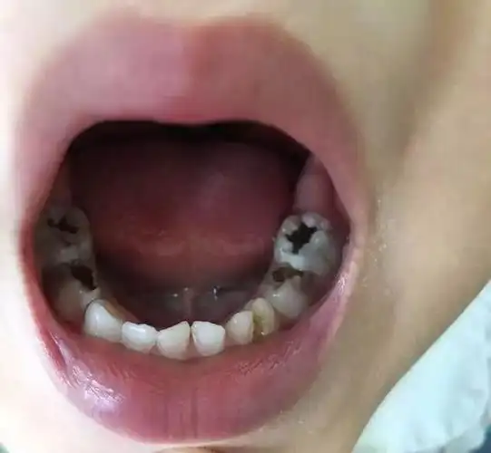 儿牙问题别担心儿童口腔专家葛立宏教授与你相约青苗