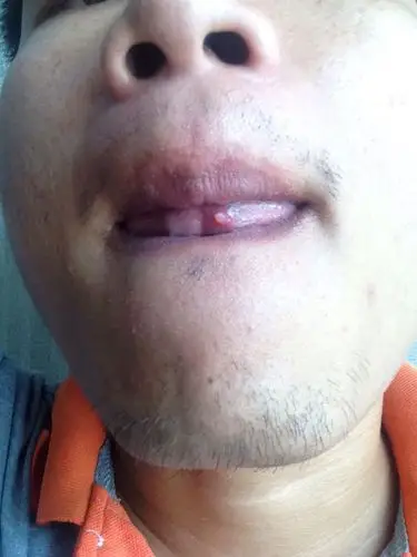 舌头底下长了一个包,有四五天了,一直没消.请问有人知道这个是啥不?