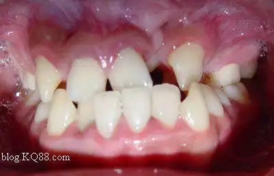 唇腭裂术后正畸