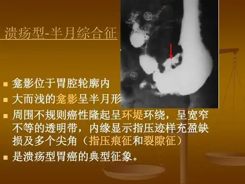 影龛位胃腔轮廓于内 大浅而的影呈半龛形月 周围规则癌不隆性起呈堤环