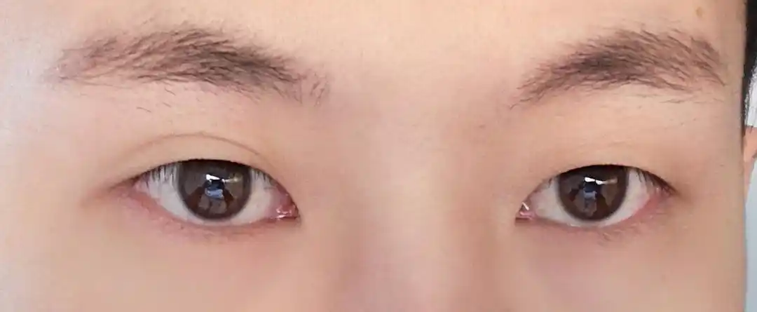 眼睛一双一单不知道要不要做双眼皮手术