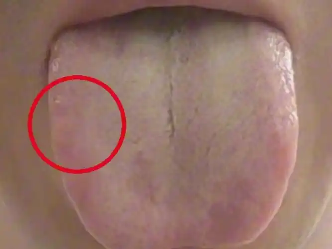 舌头中间一条裂纹,你还以为是脾肾阳虚,可就麻烦大了,这位患者的病情