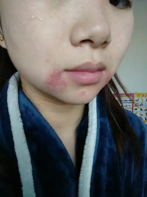 嘴角有快半年没好了,去诊所都看不出个所以然来,这两天又结痂,流黄水