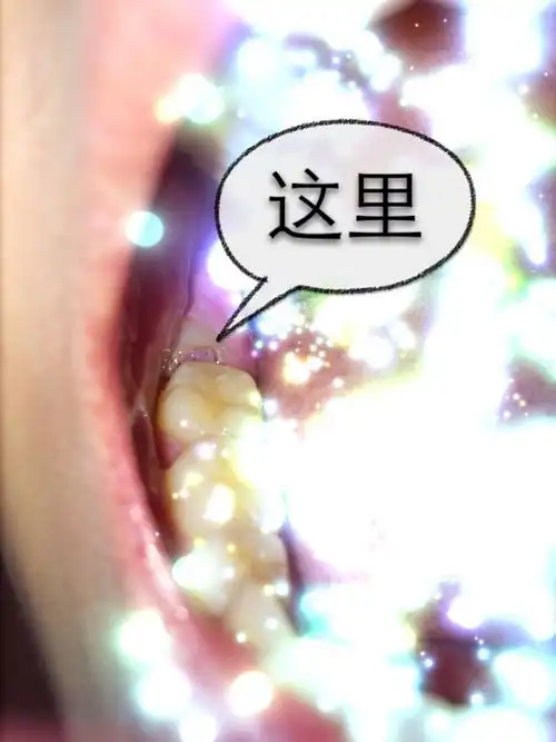 突然长出一块小肉,前几天牙龈一直肿痛,这是上火吗?还是牙息肉?