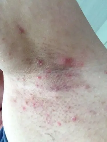 腋下长小肉粒图片5