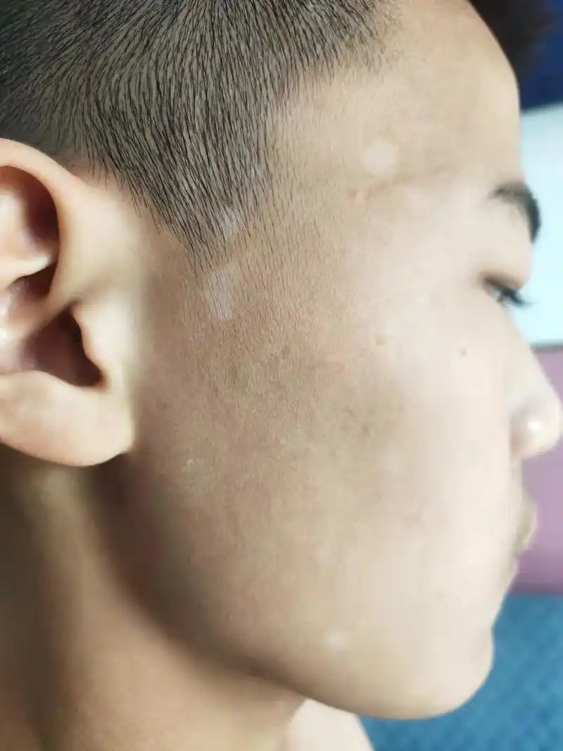 中医五色理论谈皮肤病系列之花斑癣