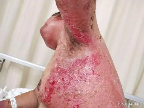 11床 热油导致全身45%面积烧伤