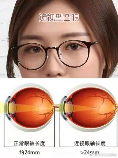 凸眼眼球突出的4大原因和眉弓改善凸眼的方法