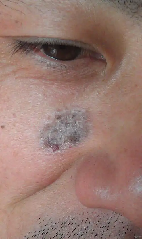 试他一手 - 皮肤及性传播疾病讨论版 - 爱爱医医学论坛