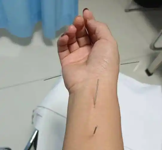 "_针灸_胳膊_局部