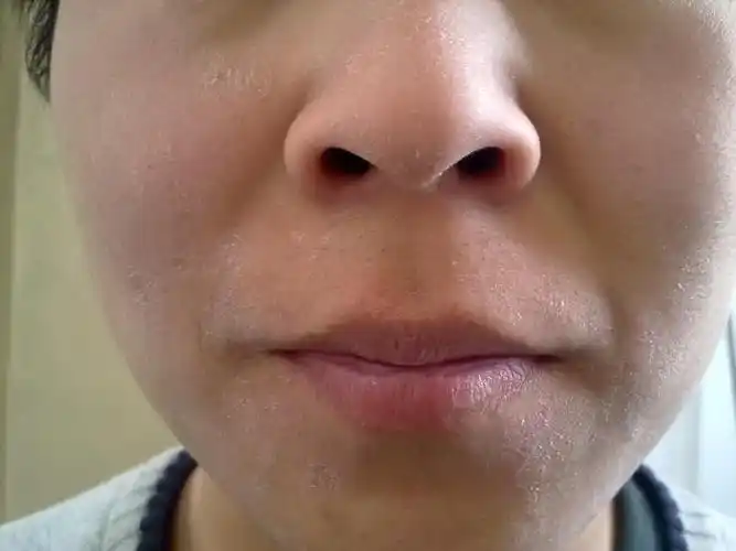 脸上皮肤疼,看起来给癣似的,是不是缺水啊