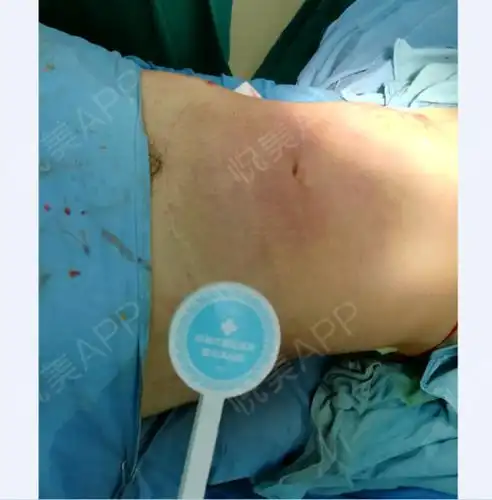 因为肚子上赘肉终于下定决心要变瘦变美也多亏了成都市西区医院整形科