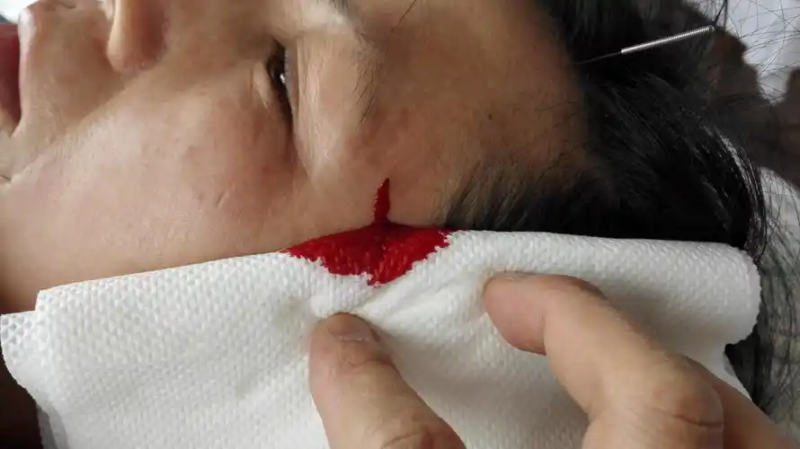 络书九宫针加刺血治疗面瘫