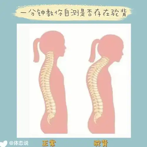 那今天就让我来告诉你吧,hh16615什么是驼背驼背,顾名思义是指