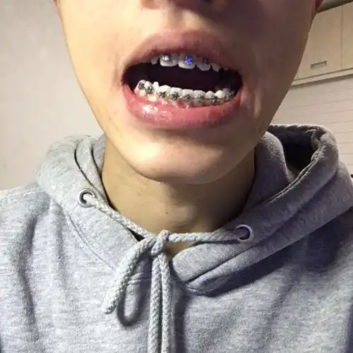 关于箍牙问题 带了有一年多了 越带感觉越奇怪 牙齿现在和脸型完全对