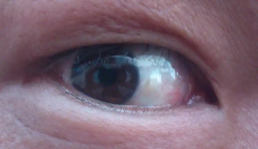 眼白处有白色物体.想请问一下这是什么,严重么