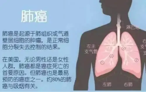 如果得了肺癌可以投什么保险 早期肺癌保险