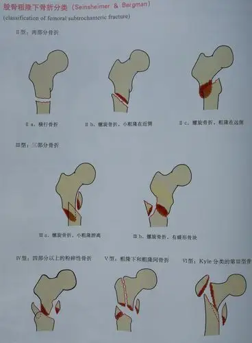pfna辅助锁定板内固定治疗股骨粗隆间粉碎骨折