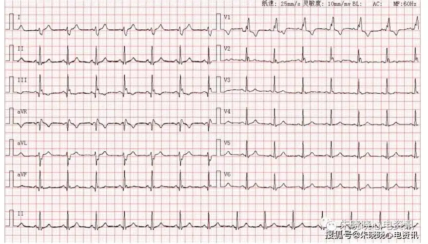 完全性右束支传导阻滞伴左后分支传导阻滞