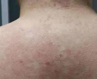 汗斑早期症状图片58