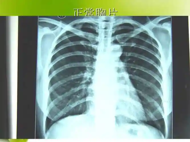 肺部常见病x线诊断ppt