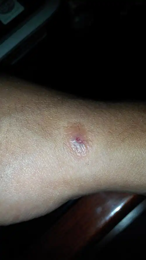 问:身上长几个硬疙瘩有半年了,不知道是被什么(虫,蚊)咬的,身体部位