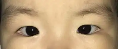 普瑞专家谈斜视:斜视也有"真"和"假",留意孩子常检查