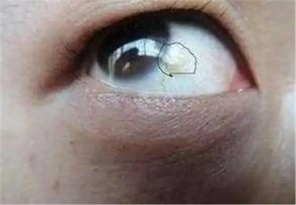 肝病早期不疼不痒如果身体有这4种症状就要重视了