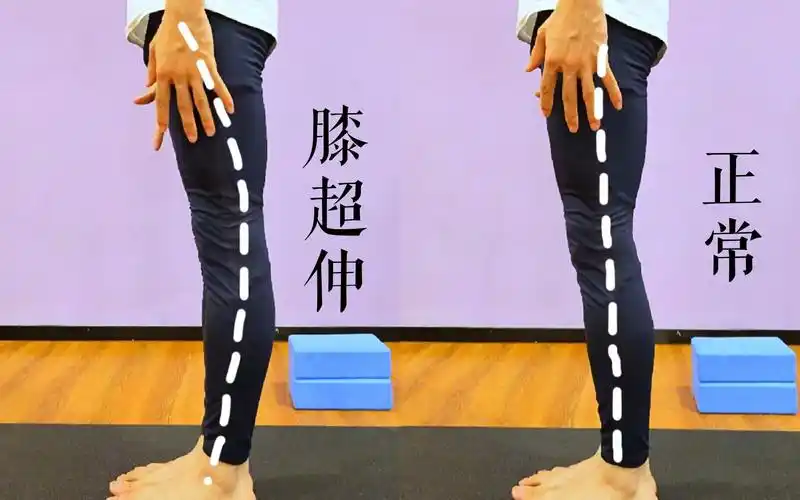 可能是膝盖超伸了,6个动作矫正膝超伸,还你完美腿型