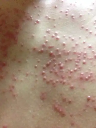 这样的疙瘩是什么?长在胸前 不疼也不痒