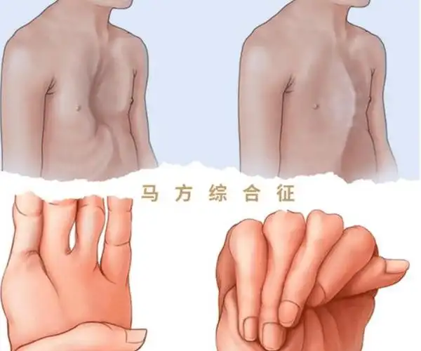 知名作家马原被质疑拒绝让13岁儿子就医去世,网友吵翻!_综合征_治疗_