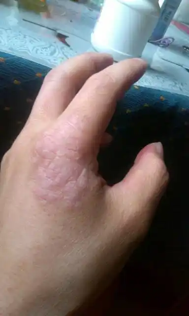 呈椭圆形,表面光滑且皮肤干燥,患处皮肤肥厚,这属于神经性皮炎