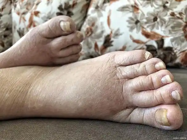 急性肾炎,主要由链球菌感染引起,前期多有感冒发热,皮肤感染等症状,多