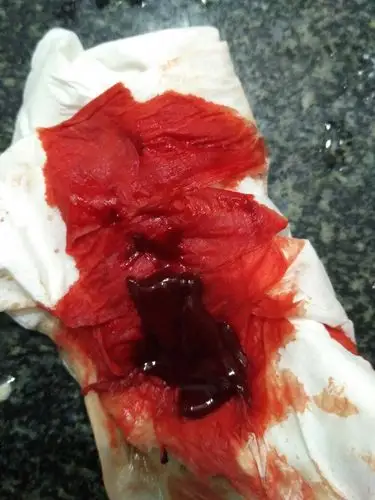 子宫膜厚15mm,来月经都15天了,经量太多了,一天一包卫生巾,晚上也要一