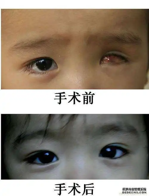 的刺激作用,使颜面部发育趋于对称,为后期的手术整形打下良好的基础