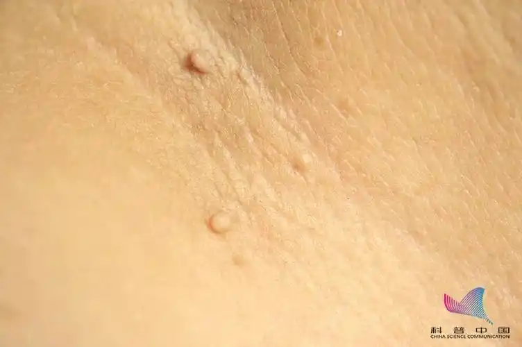 身上莫名长出的"小揪揪",皮肤病还是hpv感染了?