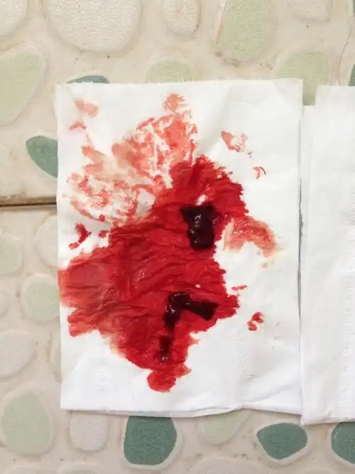 且是深色血,今天此刻突然流鲜血并伴有血块,但无腹痛,请问是流产了吗