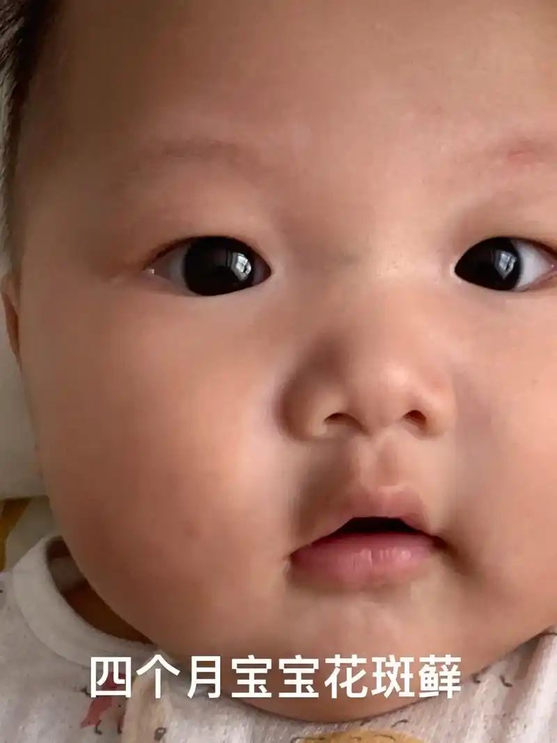 婴儿花斑藓.嘟嘟出生就有这个,之前以为是奶渍 一直没管,后来 - 抖音