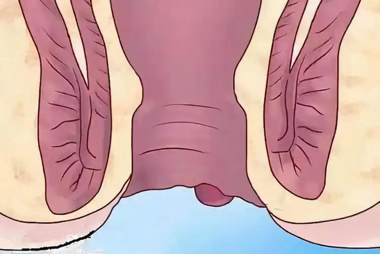 外痔疮图片(肛门外的小肉球和小肉疙瘩是什么) - 赤虎壹号