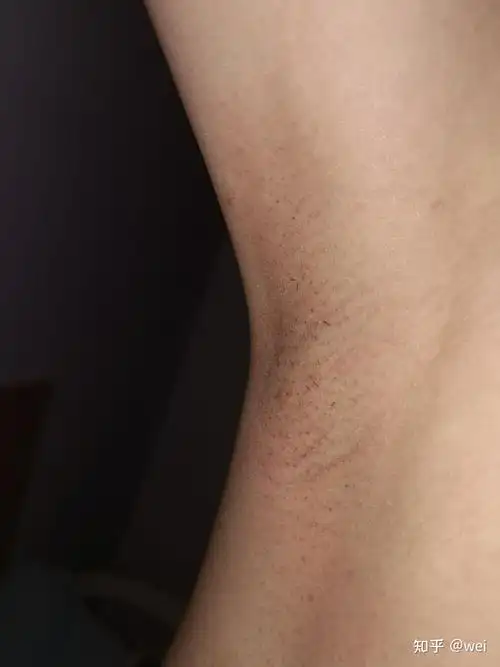 档,我新长的毛已经不扎肉了,但是我发现腋下有部分打了光的地方变黑了