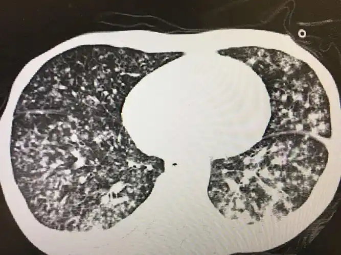 双肺弥漫性病变_肺结核