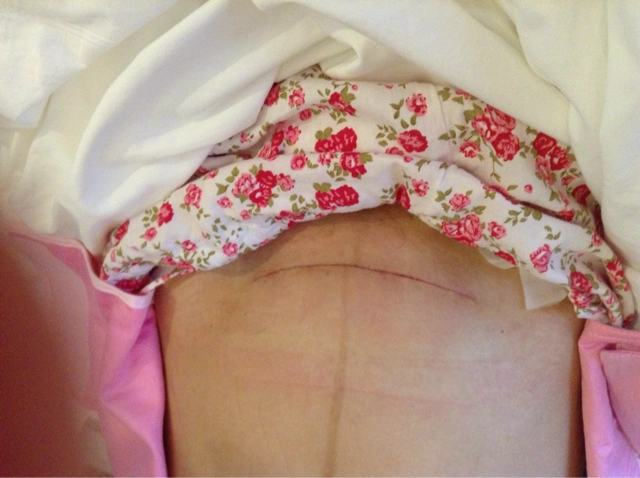 我是20日早上剖的,现在刀口有点痒