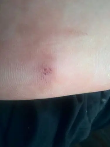 问:工地上被钉子扎了,不是特别深!