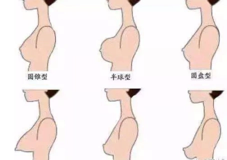 隆胸_隆胸治疗介绍 - 好大夫在线