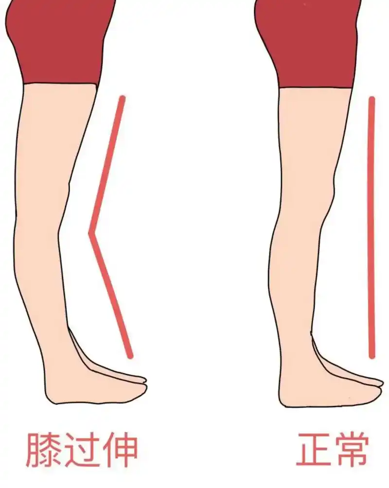 瑜伽知识分享|膝超伸的危害看看你中招没?膝超伸,又称"膝过伸 - 抖音