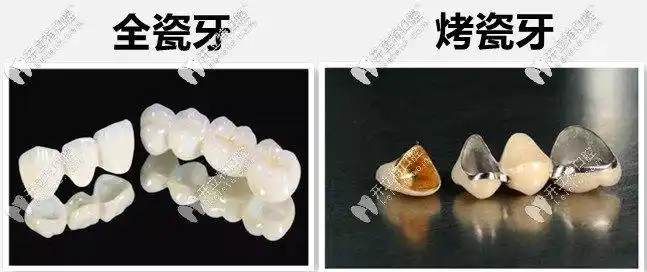 全瓷牙和烤瓷牙区别