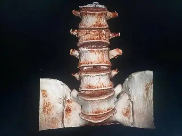 关于腰椎压缩性骨折的类型