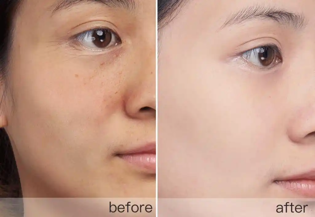 完美代替传统针刺水光针!